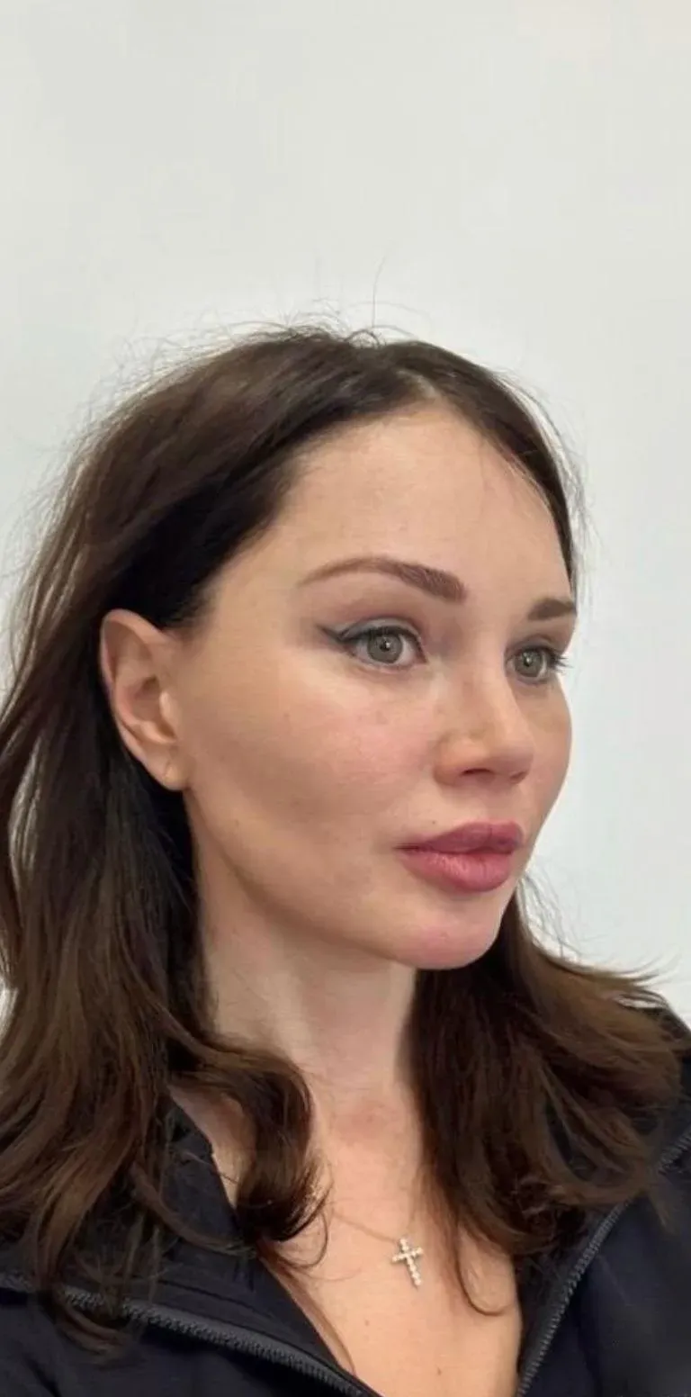 Фейслифтинг — после