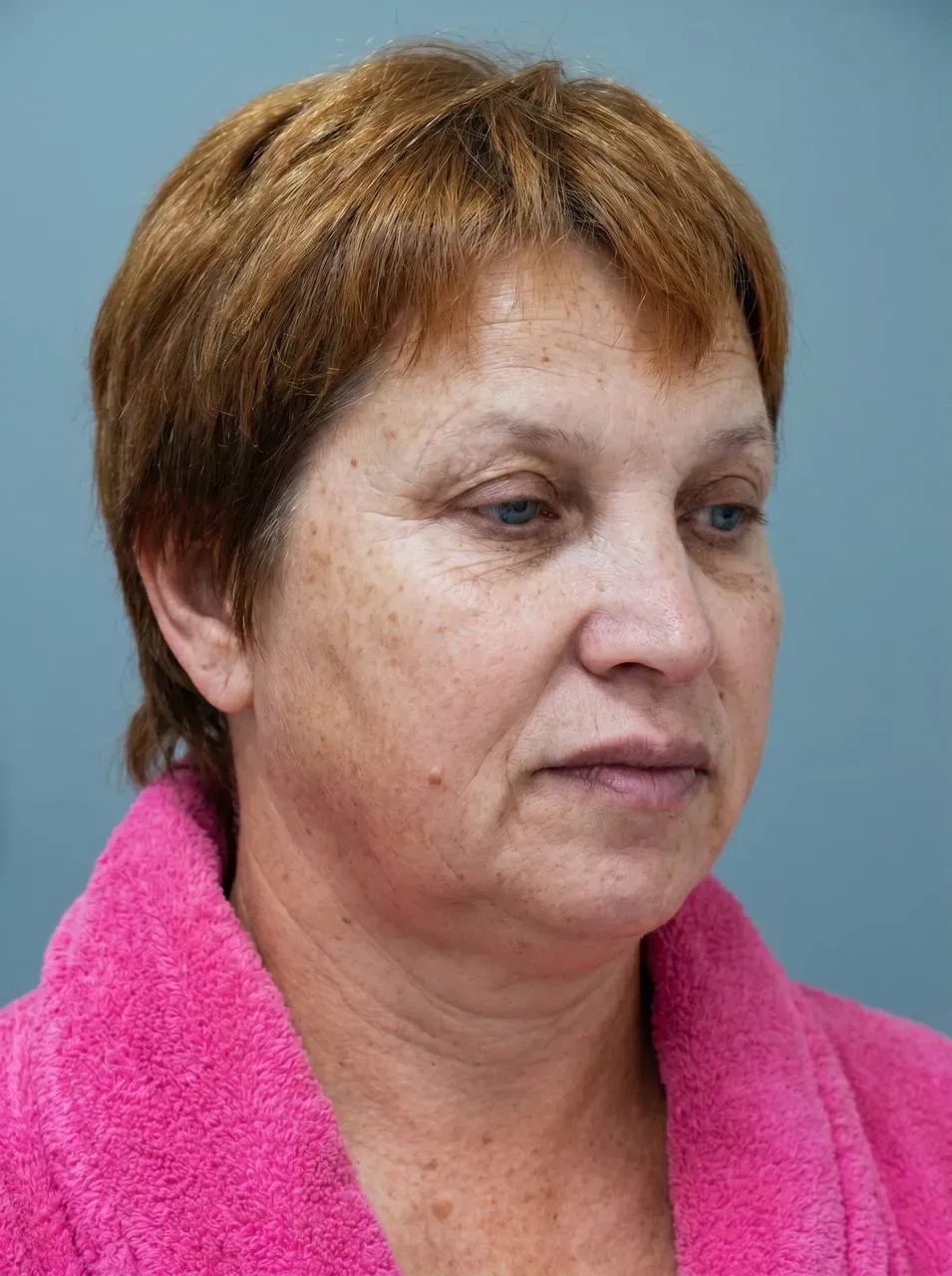 Фейслифтинг — до