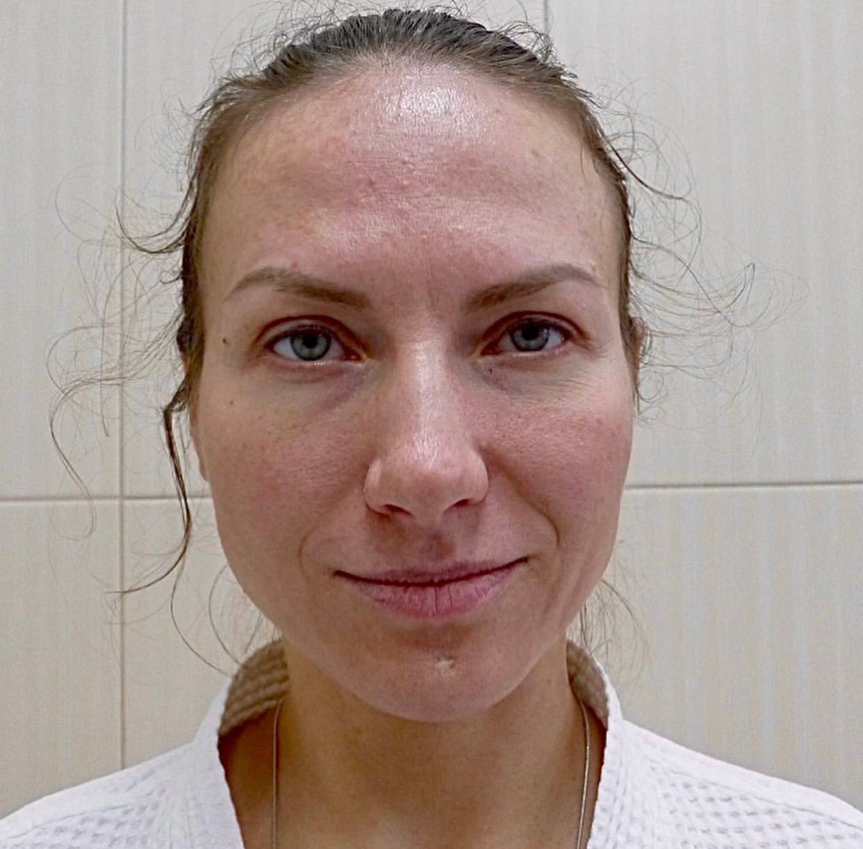 Операции средней трети лица — до