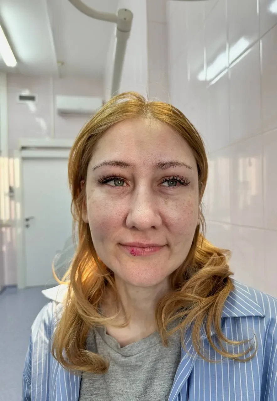 Операции средней трети лица — после