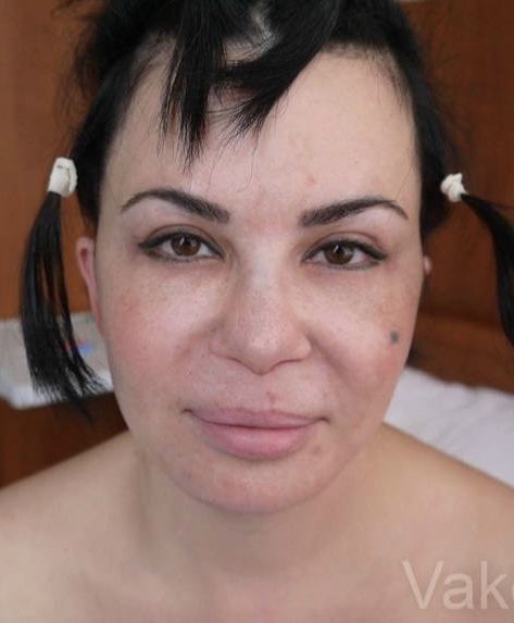 Ринопластика — до