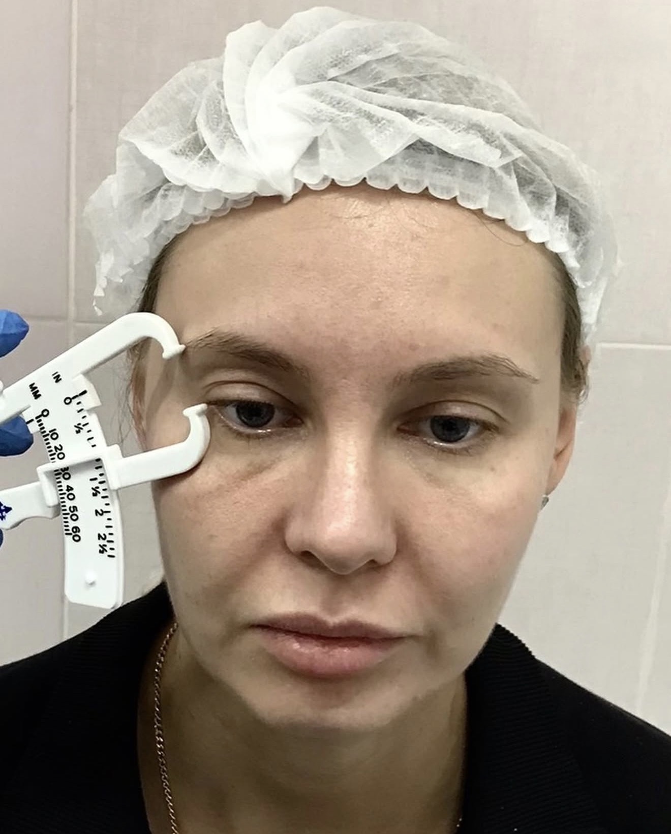 Операции верхней трети лица — до